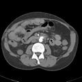 Biliary necrosis - liver transplant (Radiopaedia 21876-21845 A 31).jpg
