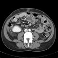 Biliary necrosis - liver transplant (Radiopaedia 21876-21846 B 44).jpg