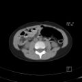 Bochdalek diaphragmatic hernia (Radiopaedia 38866-41059 A 34).jpg