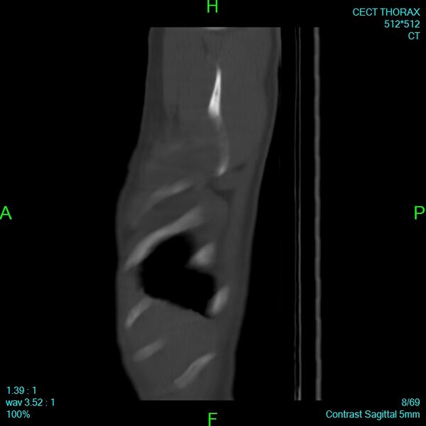 File:Bone metastases from lung carcinoma (Radiopaedia 54703-60937 Sagittal bone window 8).jpg