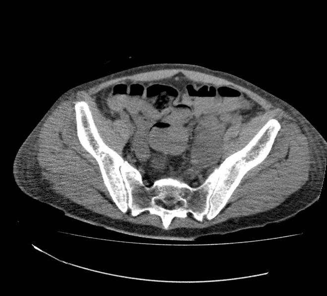 File:Bowel lymphoma complicated by bleeding after therapy (Radiopaedia 55601-62110 Axial non-contrast 67).jpg