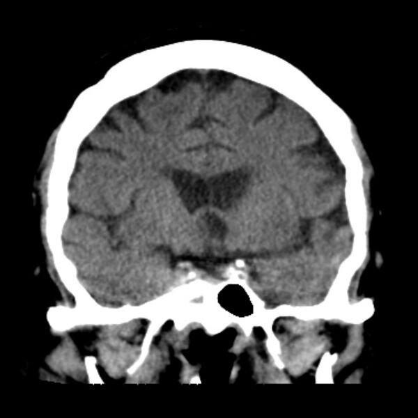 File:Brain cortical laminar necrosis (Radiopaedia 25822-25971 C 22).jpg