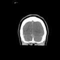 Brain death (Radiopaedia 78597-91360 Coronal non-contrast 69).jpg