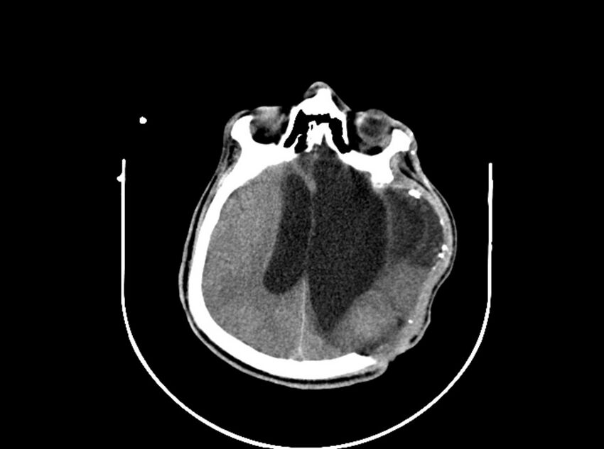 Brain injury by firearm projectile (Radiopaedia 82068-96088 A 137).jpg