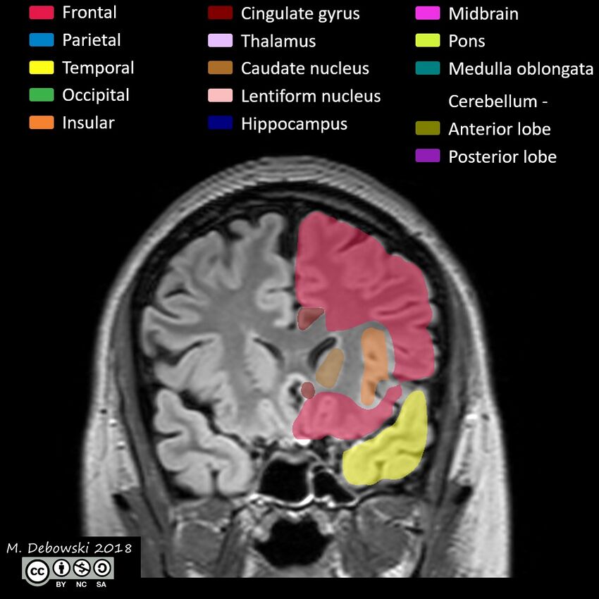 Brain lobes - annotated MRI (Radiopaedia 61691-69700 Coronal 22).JPG