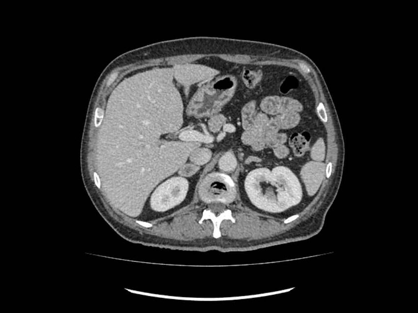 Brain metastases from renal cell carcinoma (Radiopaedia 42222-45328 B 45).jpg