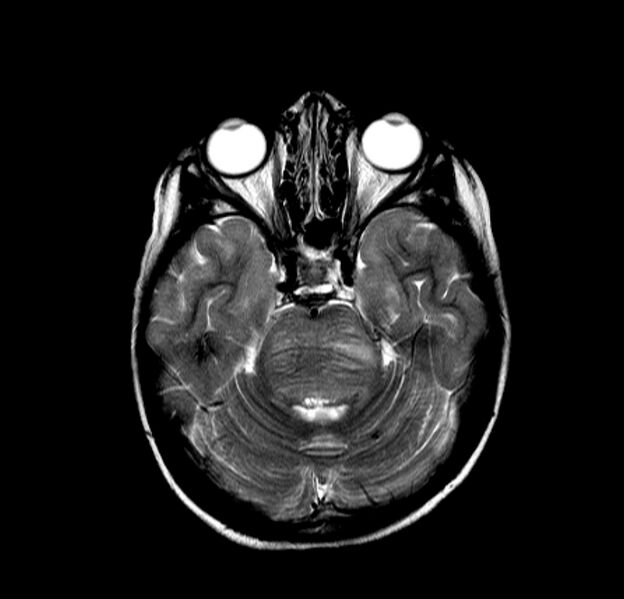 File:Brainstem glioma (Radiopaedia 5683-7390 Axial T2 4).jpg