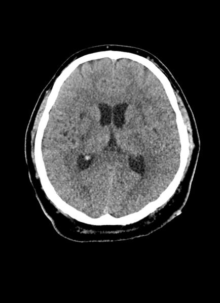 File:Brainstem hemorrhage (Radiopaedia 81294-94976 Axial non-contrast 30).jpg