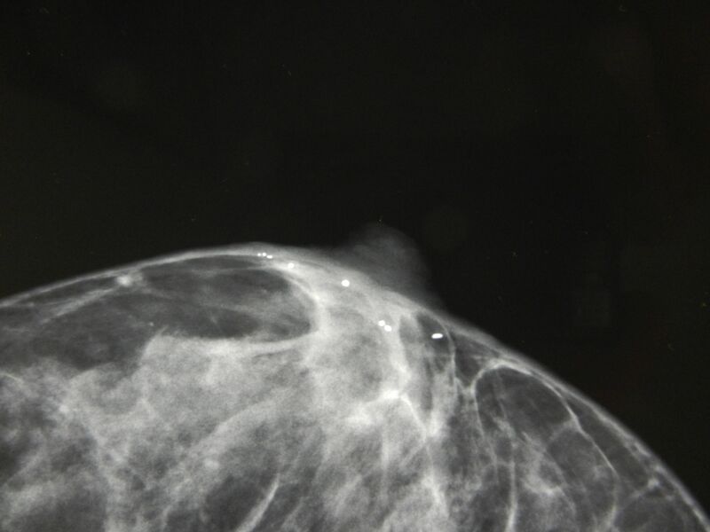 File:Breast areolar calcification (Radiopaedia 17869-17628 B 1).JPG