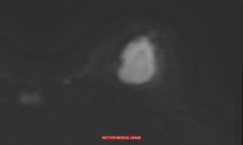 File:Breast lymphoma (MRI) (Radiopaedia 34999-36498 Axial DWI 3).jpg