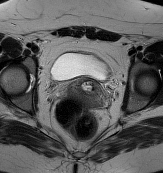 File:Broad ligament leiomyoma (Radiopaedia 81634-95516 Axial T2 17).jpg
