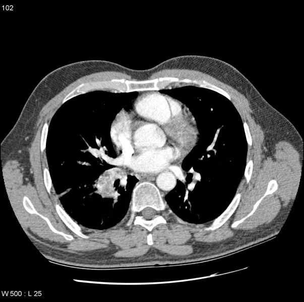 File:Bronchial arterial aneurysm (Radiopaedia 22293-22330 A 4).jpg