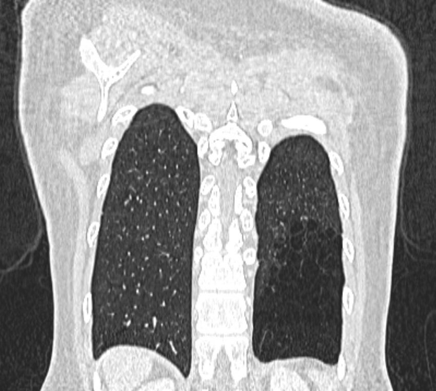 Bronchial atresia (Radiopaedia 50007-55297 Coronal lung window 103).jpg