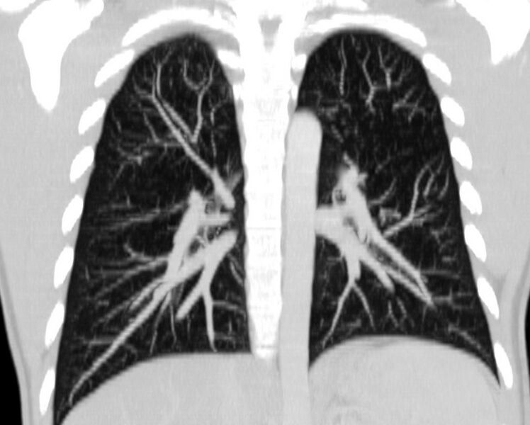 File:Bronchocele (Radiopaedia 12104-12460 Coronal lung window 3).jpg