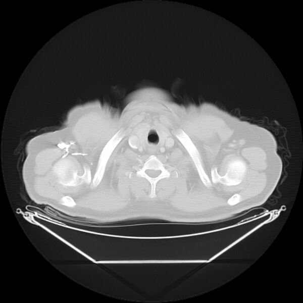 File:Bronchogenic carcinoma with upper lobe collapse (Radiopaedia 29297-29726 Axial lung window 3).jpg