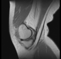 Bucket handle tear - medial meniscus (Radiopaedia 24900-25163 Sagittal T2 3).png