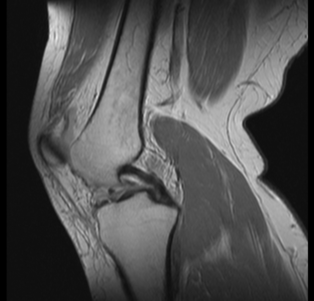 File:Bucket handle tear - medial meniscus (Radiopaedia 24900-25163 Sagittal T2 7).png