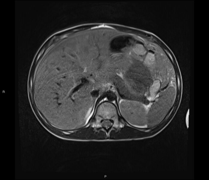 File:Burkitt lymphoma (bowel) (Radiopaedia 68839-78557 Axial T2 16).jpg