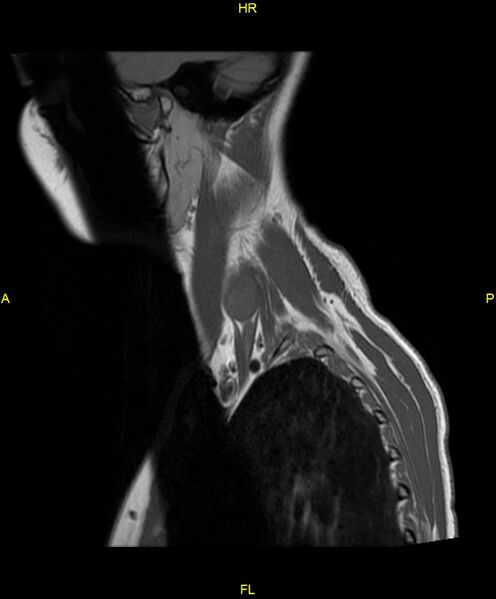 File:C5 nerve sheath tumor (Radiopaedia 85777-101596 Sagittal T1 20).jpg