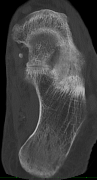 File:Calcaneonavicular coalition - bilateral osseous (Radiopaedia 11059-11464 Axial bone window 1).png