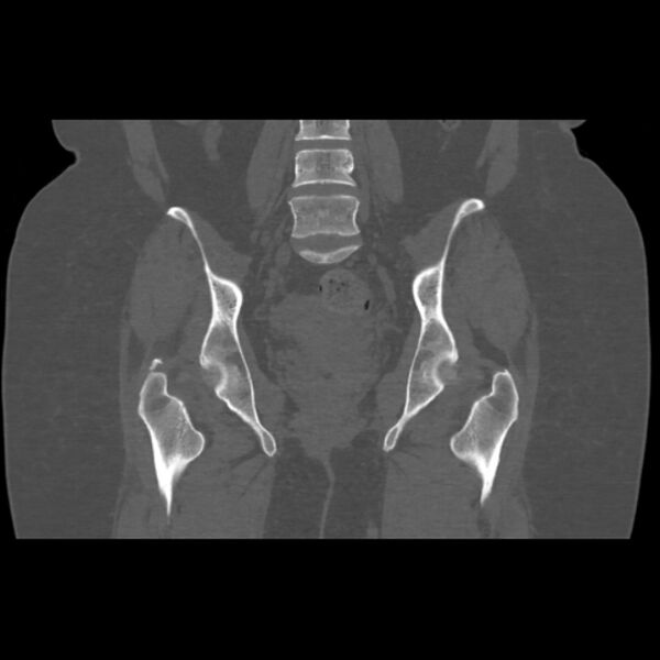 File:Calcific tendinitis of the gluteus medius muscle (Radiopaedia 66998-76318 Coronal bone window 34).jpg