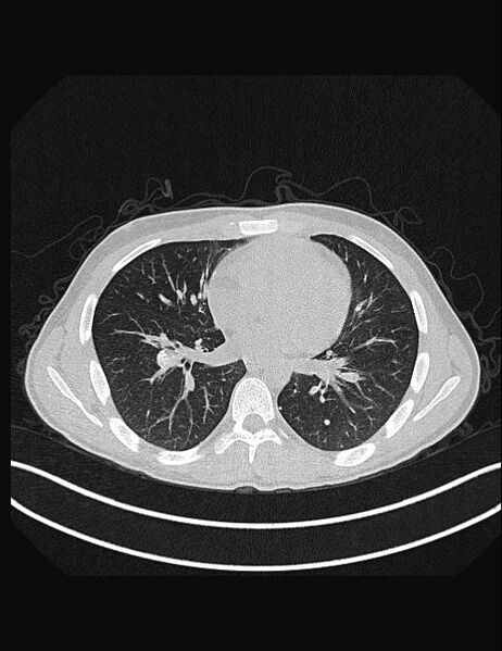 File:Calcifying pulmonary metastases (Radiopaedia 33359-34396 Axial lung window 37).jpg