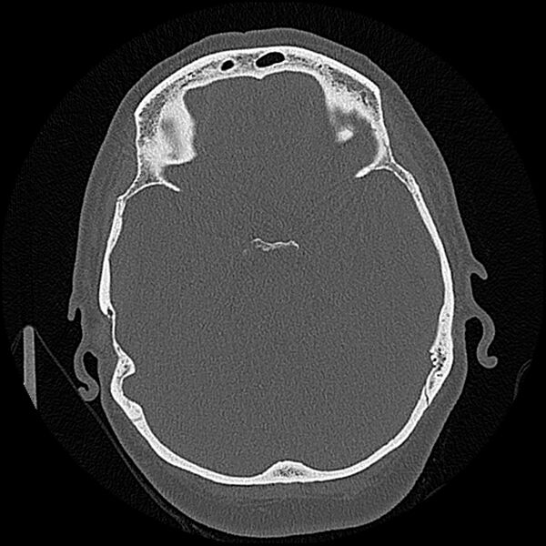 File:Canal up mastoidectomy (Radiopaedia 78108-90638 Axial bone window 117).jpg