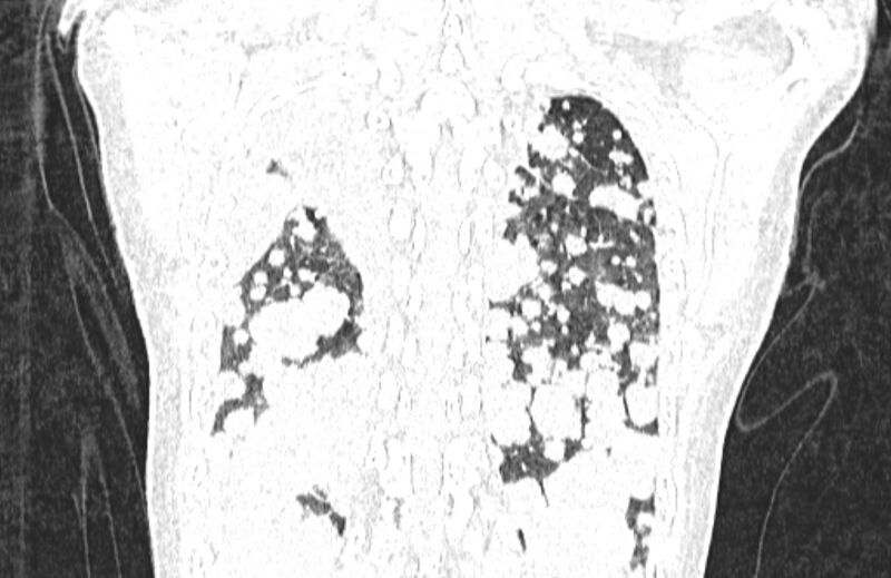 File:Cannonball metastases from breast cancer (Radiopaedia 91024-108569 Coronal lung window 124).jpg