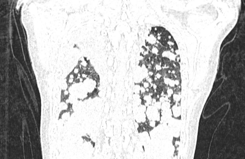 Cannonball metastases from breast cancer (Radiopaedia 91024-108569 Coronal lung window 124).jpg