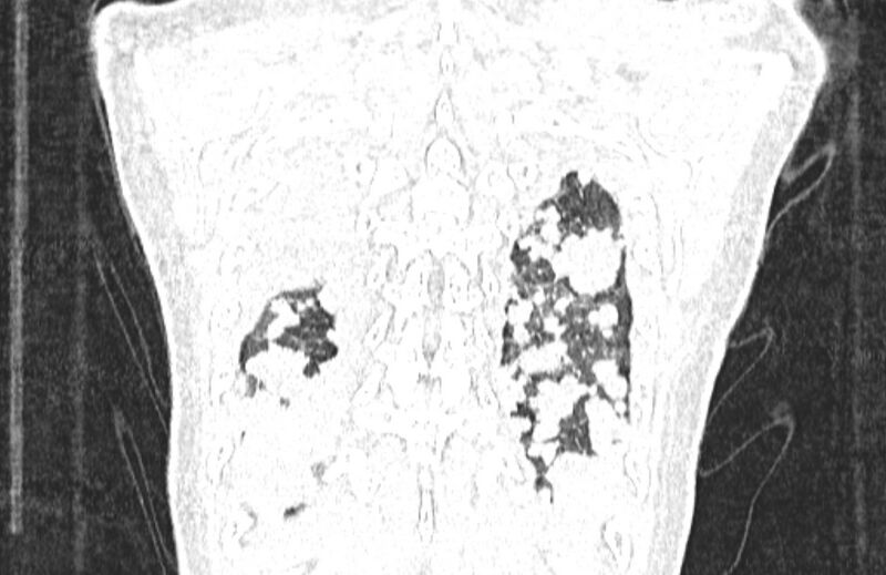File:Cannonball metastases from breast cancer (Radiopaedia 91024-108569 Coronal lung window 131).jpg