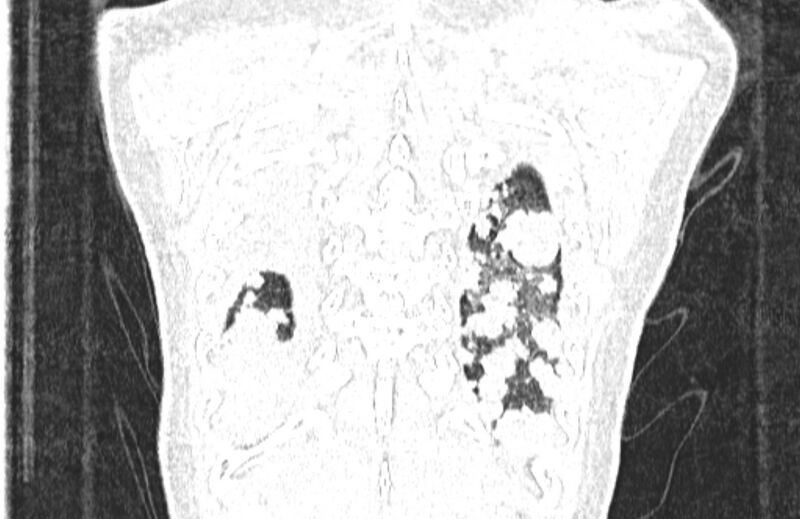File:Cannonball metastases from breast cancer (Radiopaedia 91024-108569 Coronal lung window 133).jpg
