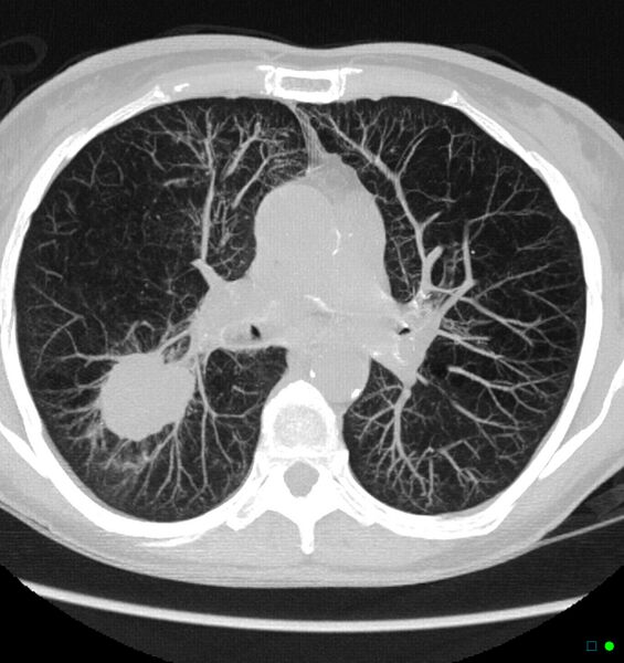 File:Carcinoma of the lung (Radiopaedia 17945-17705 Axial lung window 1).jpg