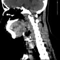 Carotid body tumor (Radiopaedia 27890-28124 C 13).jpg