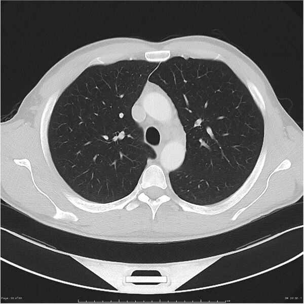 File:Cavitating lung cancer (Radiopaedia 25796-25945 Axial lung window 16).jpg