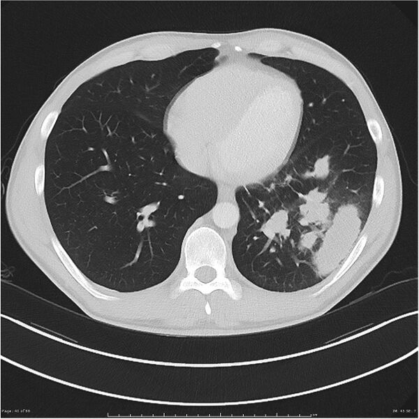 File:Cavitating lung cancer (Radiopaedia 25796-25945 Axial lung window 41).jpg