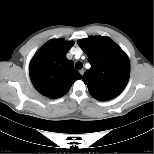 File:Cavitating lung cancer (Radiopaedia 25796-25945 C+ arterial phase 11).jpg