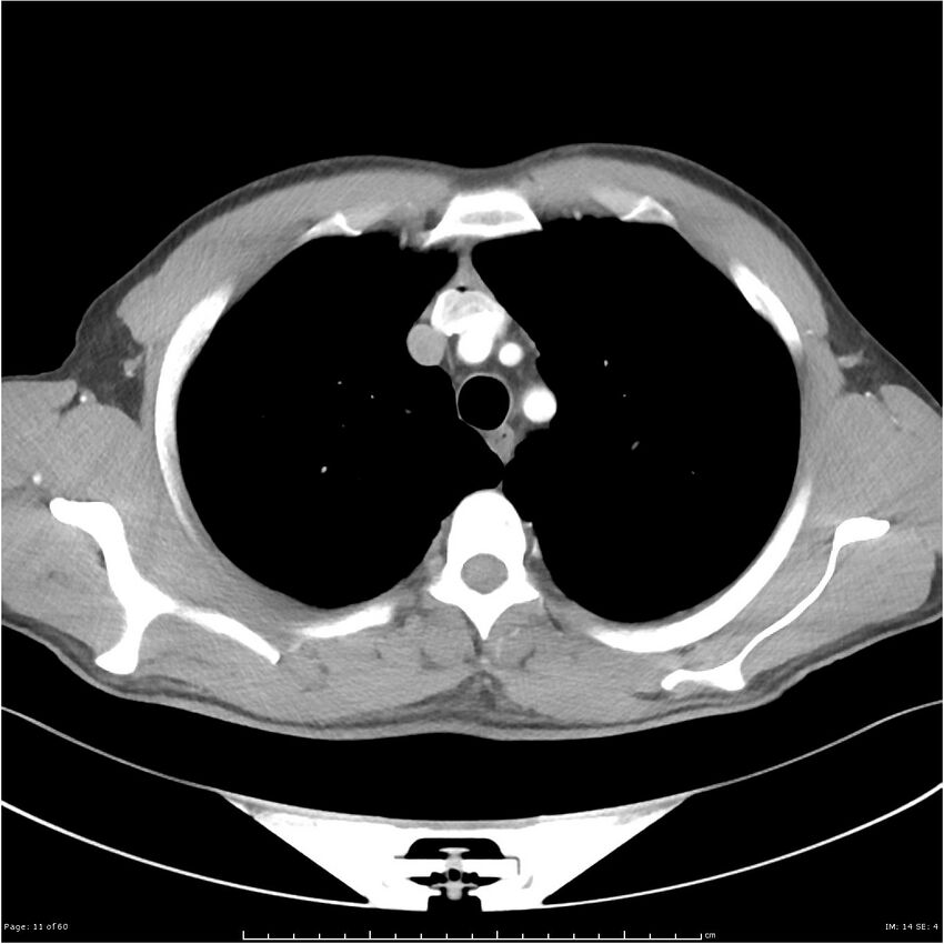Cavitating lung cancer (Radiopaedia 25796-25945 C+ arterial phase 11).jpg