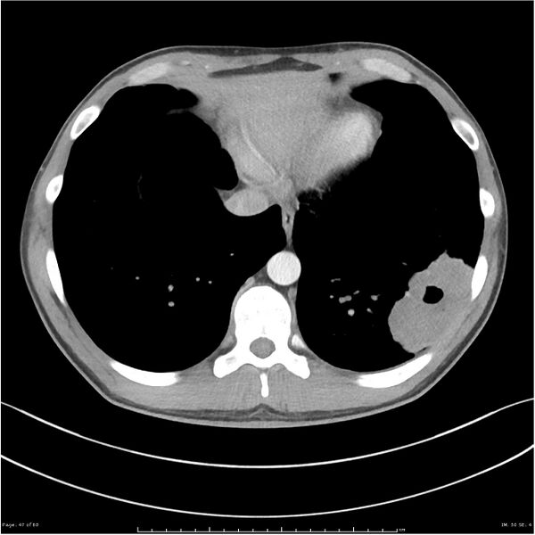 File:Cavitating lung cancer (Radiopaedia 25796-25945 C+ arterial phase 47).jpg
