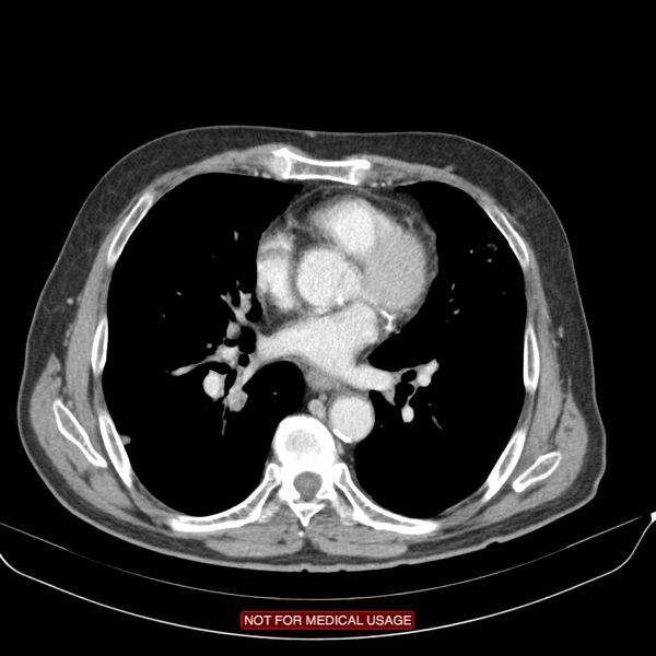 File:Cavitating pulmonary metastases (Radiopaedia 24920-25184 B 16).jpg