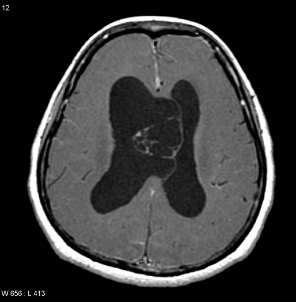 File:Central neurocytoma (Radiopaedia 4355-6613 D 1).jpg