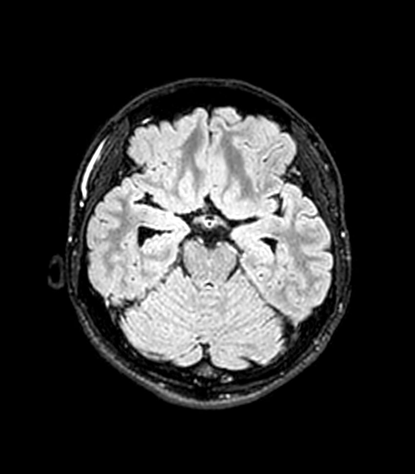 Central neurocytoma (Radiopaedia 79320-92380 Axial FLAIR 199).jpg