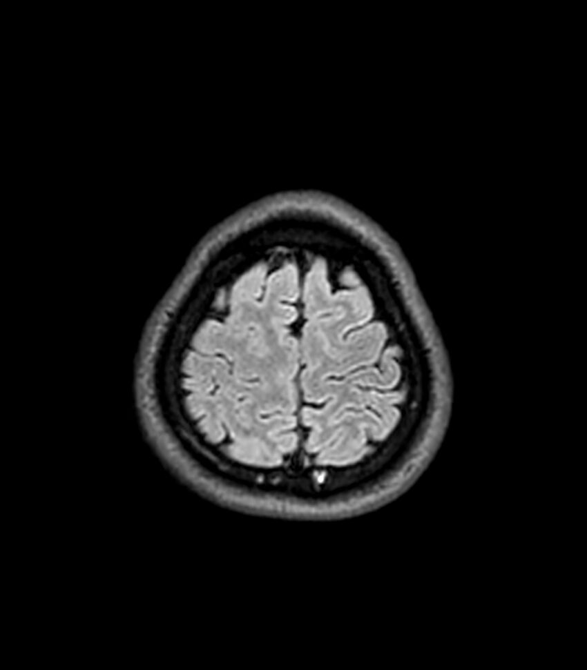 Central neurocytoma (Radiopaedia 79320-92380 Axial FLAIR 55).jpg
