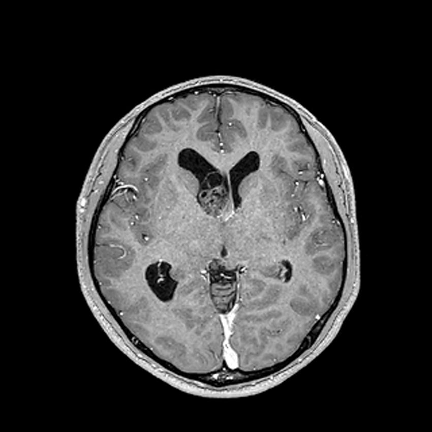 Central neurocytoma (Radiopaedia 79320-92380 Axial T1 C+ 121).jpg