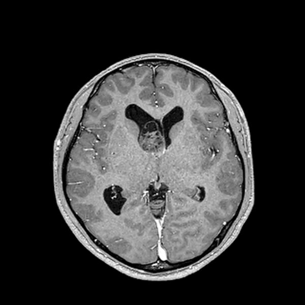 File:Central neurocytoma (Radiopaedia 79320-92380 Axial T1 C+ 123).jpg