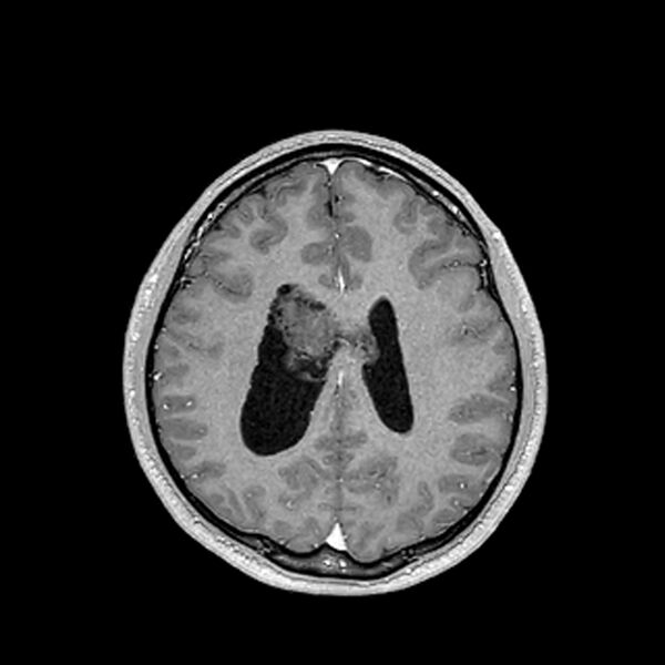 File:Central neurocytoma (Radiopaedia 79320-92380 Axial T1 C+ 162).jpg