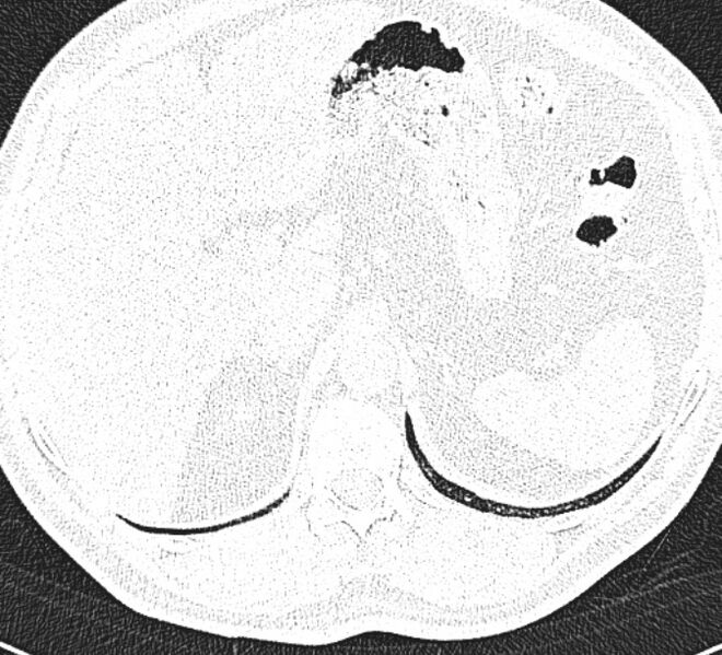 File:Centrilobular pulmonary emphysema (Radiopaedia 26808-26971 Axial lung window 39).jpg