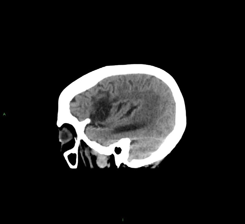 Cerebellar hemorrhage (Radiopaedia 58793-66027 C 14).jpg
