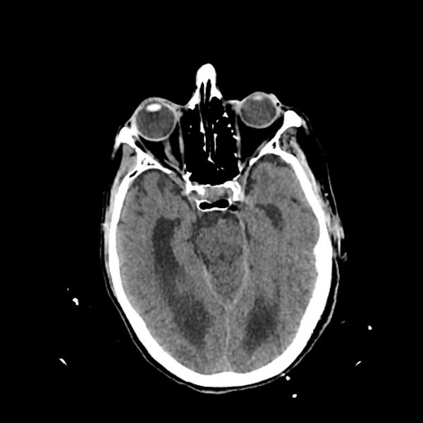 File:Cerebellar metastasis - lung tumor (Radiopaedia 69317-79145 Axial non-contrast 13).jpg