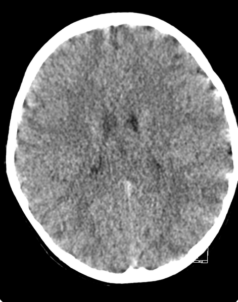 File:Cerebellar stroke (Radiopaedia 32202-33149 Axial non-contrast 16).png