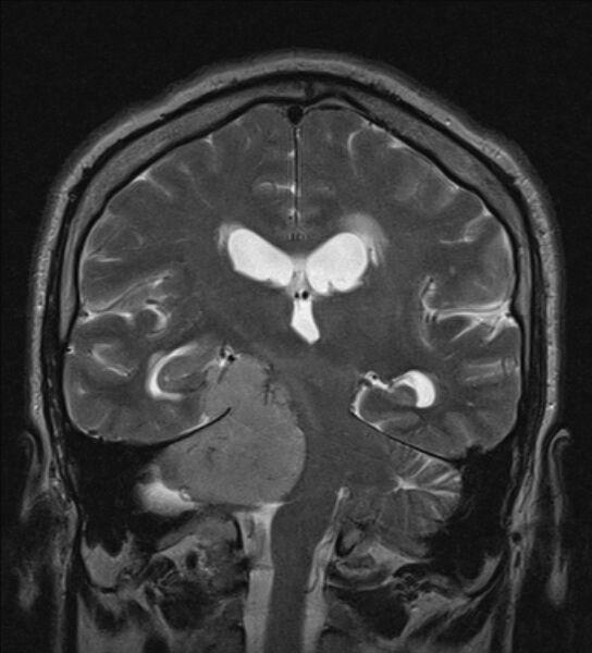 File:Cerebellopontine angle meningioma (Radiopaedia 24459-24764 Coronal T2 14).jpg